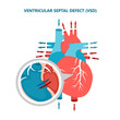 Ventricular septal defect VSD with heart blood flow. Human heart muscle diseases cross-section.