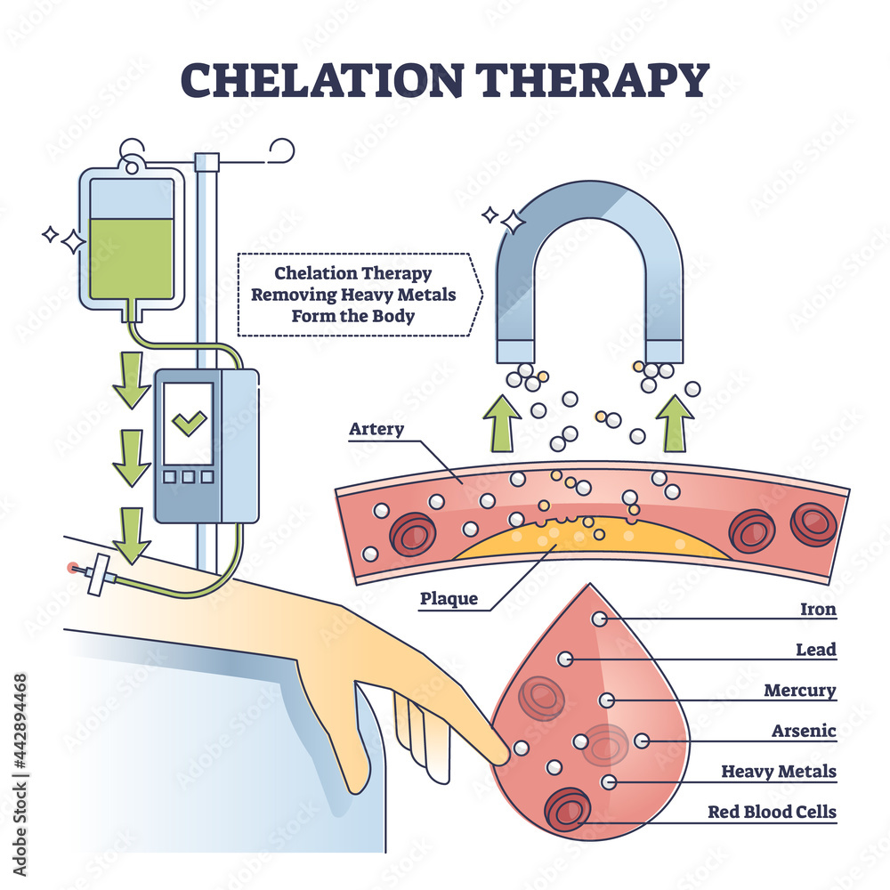 Oil Injection Bloodstream เวกเตอร์ Stock Chelation therapy for toxic heavy metal medical ...