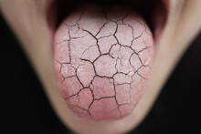 Woman Unhealthy Cracked Dry Tongue