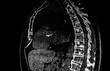 Spine CT Scan showing metastatic tumoral lesions