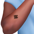 Illustration showing melanoma on the arm. A cancer arising from the skin's melanocytes, the cells that produce the pigment melanin that gives skin its colour.