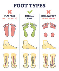 Poster - Foot types with flat, normal and hollow feet comparison in outline diagram. Educational medical explanation side view with orthopedic leg and medical deformation vector illustration. Footprint shapes.