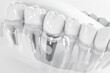 Detail of a false tooth implant fixed in the jaw