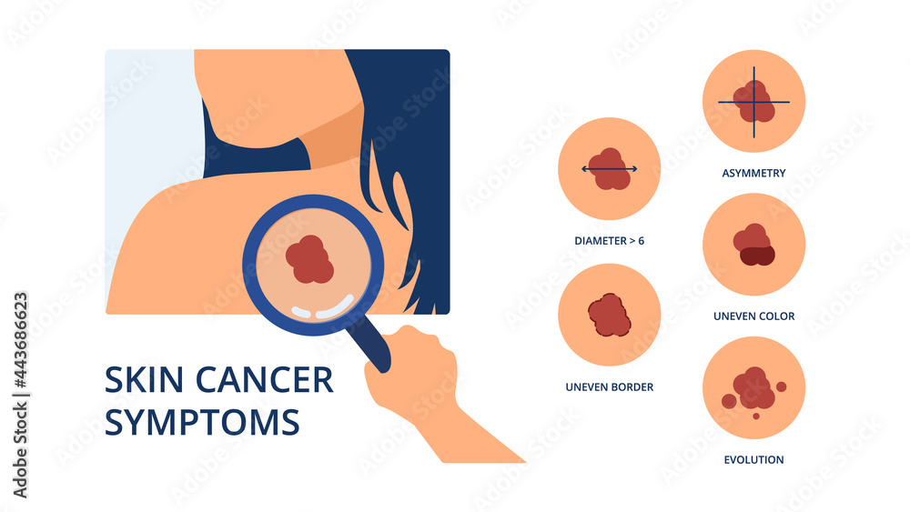 Skin cancer symptoms like big diameter, asymmetry, uneven color, uneven ...