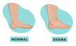 A swollen foot and ankle and a normal foot. Edema.  Vector illustration