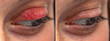 © Alessandro Grandini - Human eye upper eyelid chalazion before and after side by side blepharitis comparison