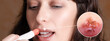 © Alessandro Grandini - Girl who is treating a Herpes simplex infection with an anti-viral cream-based lip stick. Banner proportions
