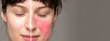 © Alessandro Grandini - signs and symptoms of rosacea: natural cures in the treatment of skin disorders