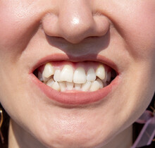 Curved Female Teeth, Before Installing Braces. Close - Up Of Teeth Before Treatment By An Orthodontist
