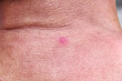 Red rash skin background on back of  asian old man neck
