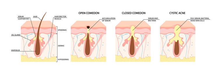 Types of acne. Open comedones, closed comedones, inflammatory acne, cystic acne. Healthy skin care concept