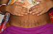 Close up of a scar on the belly created from Cesarean section or C-section or surgical delivery operation . a cesarean scar after one week . Delivery by Caesarean section selective focus.