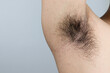 A man who raised his arms to show off his armpits full of long hair and the marks of a rash.