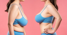 Before And After Breast Augmentation Concept, Woman With Very Large Silicone Breasts After Correction Surgery