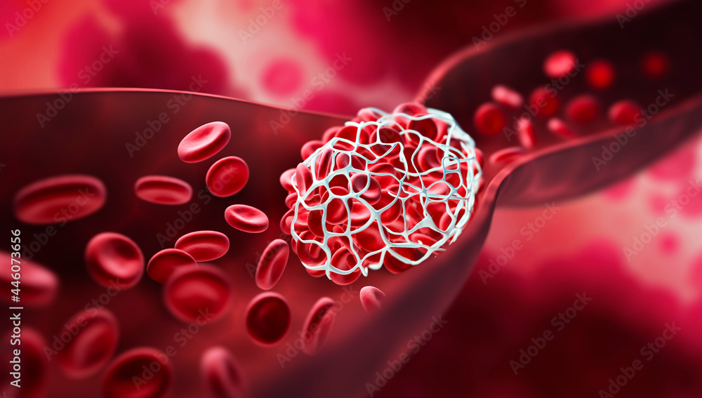 Blood clot blocking a blood vessel - obrazy, fototapety, plakaty 