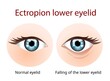 Ectropion Lower eyelid, Ectropion is a condition in which your eyelid turns outward