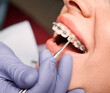 Close up of dentist hand in serial glove putting elastic rubber band on patient brackets. Woman with wired metal braces on teeth receiving orthodontic treatment in dental clinic. Concept of dentistry.