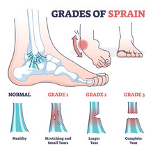 Grades Of Sprain As Ankle Or Foot Medical Injury Levels Outline Diagram. Anatomical Leg Problem Significance Measurement And Division Vector Illustration. Healthy, Stretching And Tears Explanation.