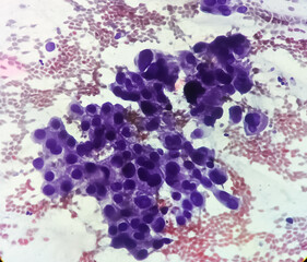 Poster - Photomicrograph showing adenocarcinoma of gallbladder. Gallbladder cancer, 40X