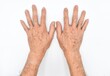 Age spots on hands of Asian elder man. They are brown, gray, or black spots and also called liver spots, senile lentigo, solar lentigines, or sun spots.