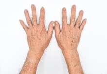 Age Spots On Hands Of Asian Elder Man. They Are Brown, Gray, Or Black Spots And Also Called Liver Spots, Senile Lentigo, Solar Lentigines, Or Sun Spots.