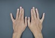 Bilateral little finger deviation in Asian young man. Bilateral hand deformities. Abnormal fingers extension.