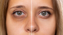 Cropped Shot Of A Young Female Face. Female Green Eyes With Bruise Under Eye Before And After Cosmetic Treatment. Dark Circles Under The Eyes
