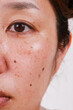Macro skin, face, woman, portrait with large pores Dark spots care for problem skin with