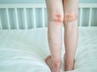 © Alyona Shu - Eczema on kid's legs. Atopic dermatitis close up. Allergy spots and red itchy skin inflammation on child's feet