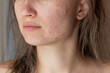 Cropped shot of a young woman's face with the problem of acne. Pimples, red scars on cheeks and chin. Allergies, dermatitis, rash. Problem skin, care and beauty concept. Dermatology, cosmetology