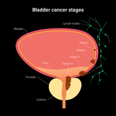 Canvas Print - Bladder cancer stages