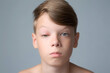 Portrait of a boy with a swollen eye from an insect bite. Allergic reaction to insect bites. Closed red sick eye of a teen boy. Eye disease in a child, conjunctivitis, inflammation in the eye.