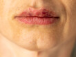 Beautiful middle aged woman with a bruise on her lips after lip augmentation with hyaluronic acid. Injection cosmetology concept. Front view, horizontal