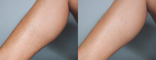 Image Before And After Leg Hairs Removal Concept.