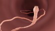 Tapeworm in the intestine, Parasitic infection illustration