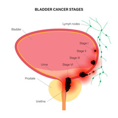 Canvas Print - Bladder cancer stages