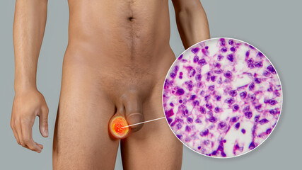 Poster - Testicular cancer, 3D illustration