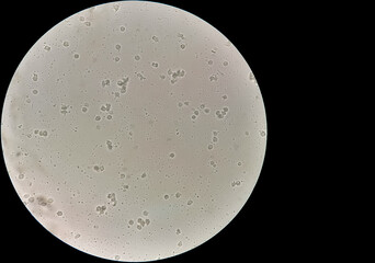 Poster - Sperm or semen test or analysis. Azoospermia with plenty pus cells seen. infertily. no sperm