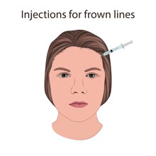Injections For Frown Lines, Illustration