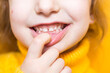 © Ольга Симонова - Girl shows her teeth-pathological bite, malocclusion, overbite. Pediatric dentistry and periodontics, bite correction. Health and care of teeth, caries treatment, baby teeth. Upper jaw rests on gum.
