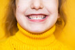© Ольга Симонова - Girl shows her teeth-pathological bite, malocclusion, overbite. Pediatric dentistry and periodontics, bite correction. Health and care of teeth, caries treatment, baby teeth. Upper jaw rests on gum.