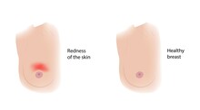Healthy Breast And Redness Of The Skin, Illustration
