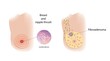© Science RF - Fibroadenoma and breast thrush, illustration