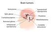 © Science RF - Brain tumour with explanations, illustration