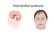 © Science RF - Foetal alcohol syndrome, illustration