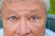 Eyes of a senior man showing unequal pupil dilation