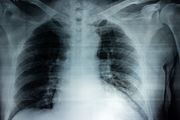 Naklejka na meble Film X-ray of breast a person