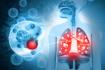 Wall Mural - Lung cancer diagnosis and Human lungs disease. 3d illustration