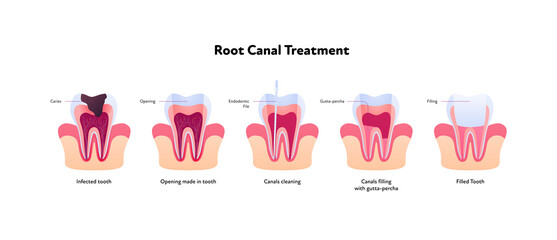 Tooth decay and root canal treatment chart. Vector biomedical illustration. Cross section. Teeth in gum feeling steps isolated on white background. Design for dental oral healthcare, dentistry