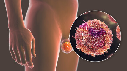 Poster - Testicular cancer, medical 3D illustration